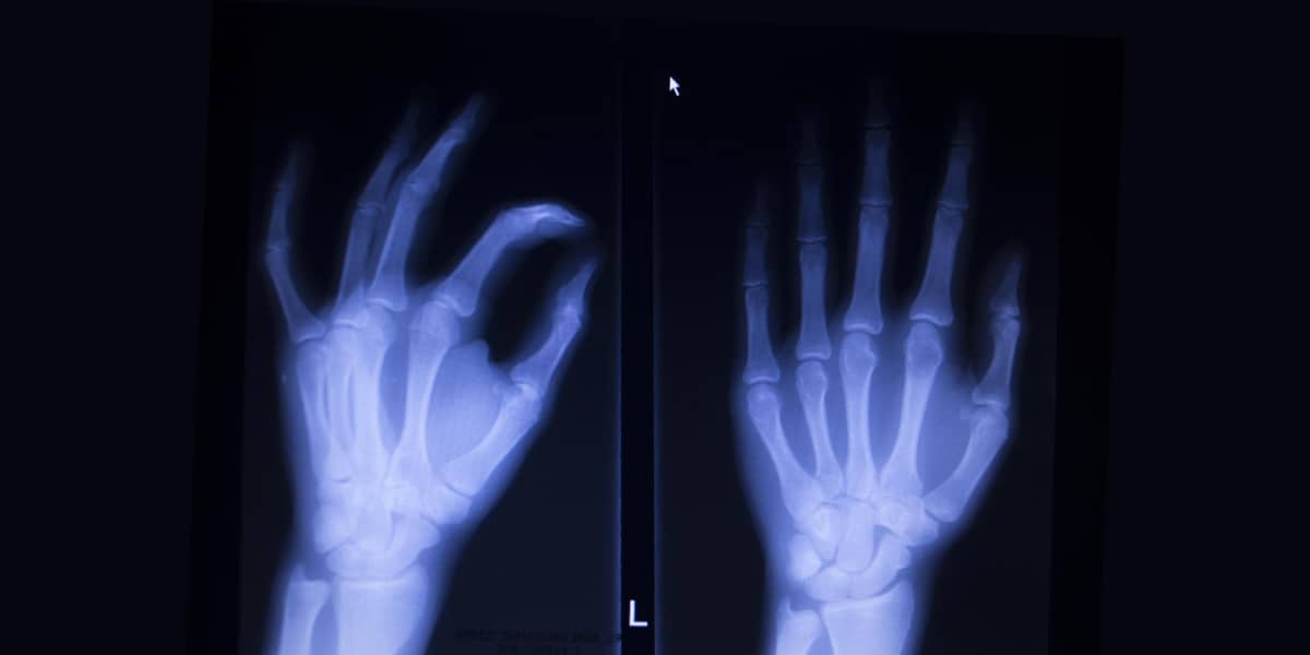 Röntgebild hand